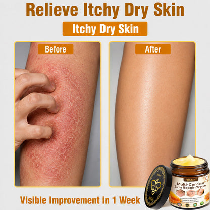 🎁 DON’T LEAVE THIS VIP DEAL BEHIND 80% OFF HISKIN® Skin Repair Cream | Smooth The Look Of Wrinkles, Hydrate & Restore A Youthful Glow + 180-Day Guarantee