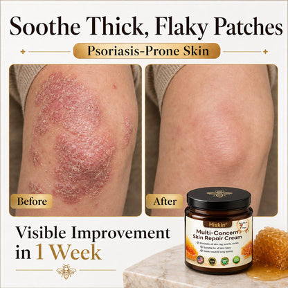 ✨🐝𝐇𝐈𝐒𝐊𝐈𝐍® 𝐌𝐮𝐥𝐭𝐢-𝐂𝐨𝐧𝐜𝐞𝐫𝐧 𝐒𝐤𝐢𝐧 𝐑𝐞𝐩𝐚𝐢𝐫 𝐂𝐫𝐞𝐚𝐦 (𝐎𝐧𝐞 𝐩𝐨𝐰𝐞𝐫𝐟𝐮𝐥 𝐜𝐫𝐞𝐚𝐦 𝐭𝐨 𝐫𝐞𝐩𝐚𝐢𝐫 𝐢𝐧𝐟𝐥𝐚𝐦𝐦𝐚𝐭𝐢𝐨𝐧, 𝐝𝐫𝐲𝐧𝐞𝐬𝐬, 𝐚𝐠𝐢𝐧𝐠, 𝐩𝐢𝐠𝐦𝐞𝐧𝐭𝐚𝐭𝐢𝐨𝐧, 𝐚𝐧𝐝 𝐯𝐢𝐬𝐢𝐛𝐥𝐞 𝐬𝐤𝐢𝐧 𝐝𝐚𝐦𝐚𝐠𝐞.)